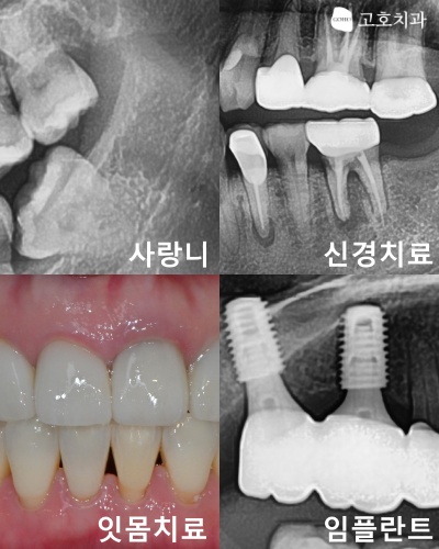 수면치료로 받을 수 있는 치과 치료 종류
