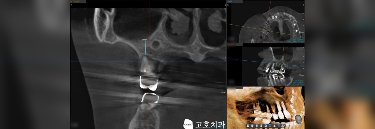임플란트 CT 진단 임상 이미지