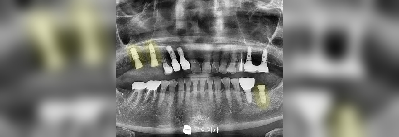 픽스처 식립 임상 케이스