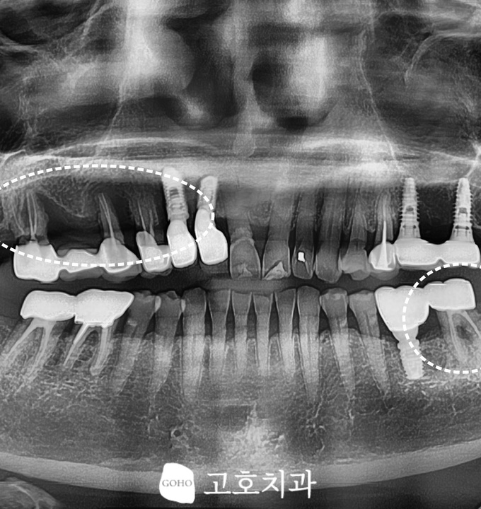수면마취 임플란트 적합 대상