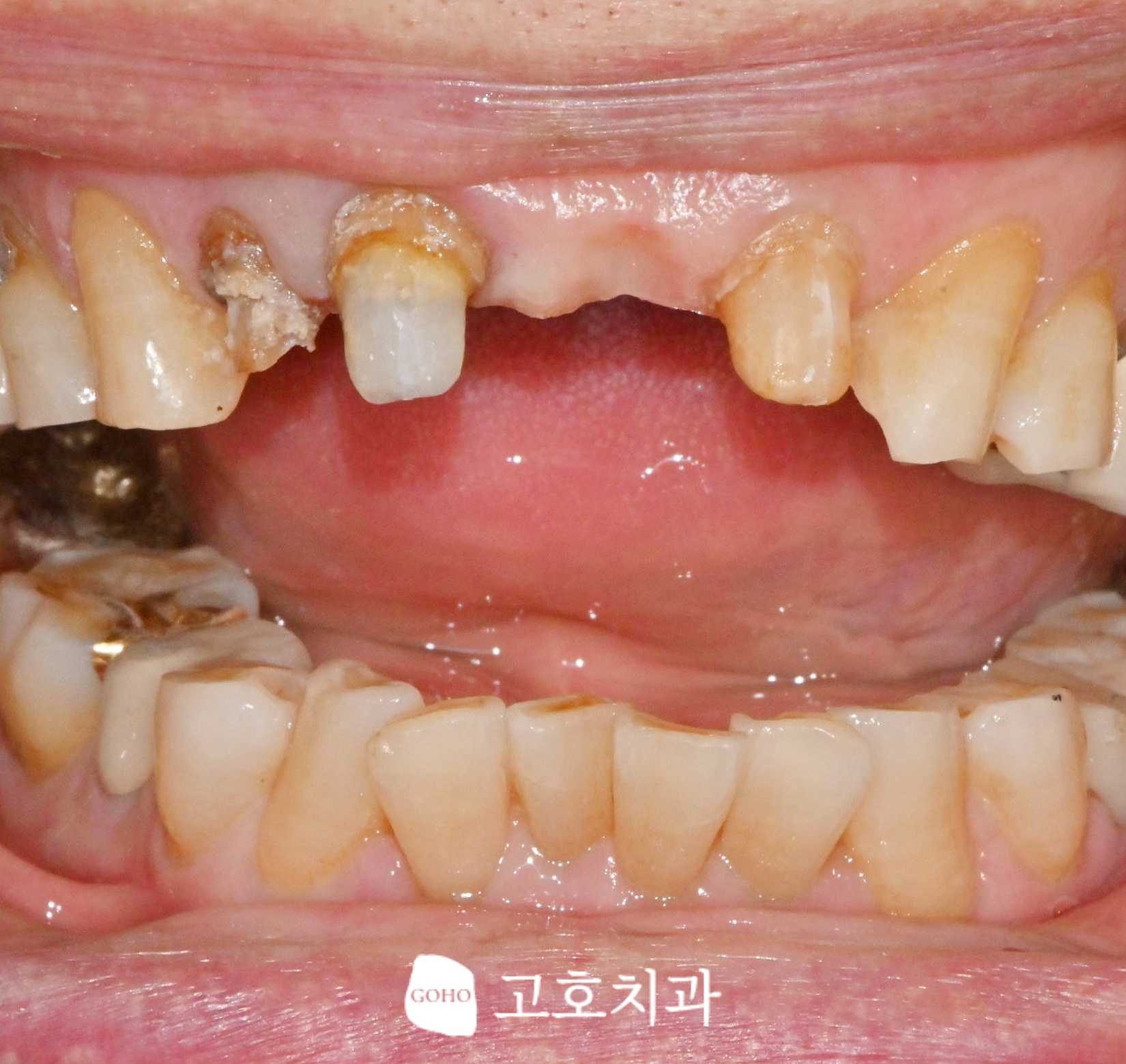 노후 보철물 마진 변색 확인