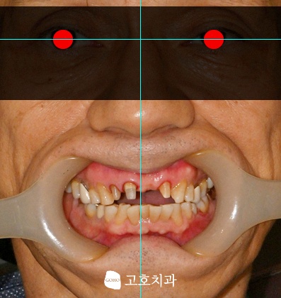 안모 기준 촬영을 통한 심미보철 설계
