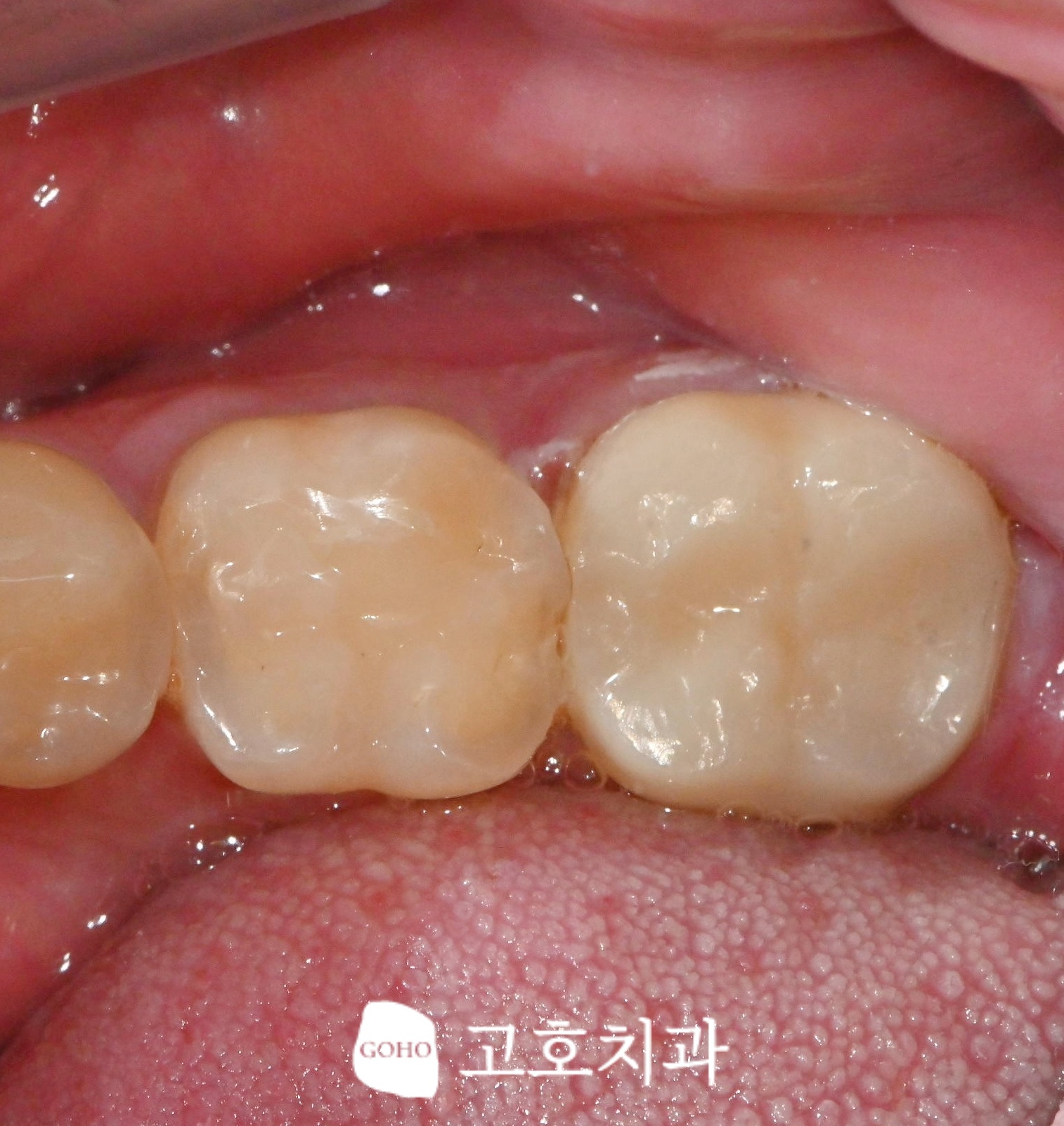 지르코니아 크라운 소재와 색조 비교