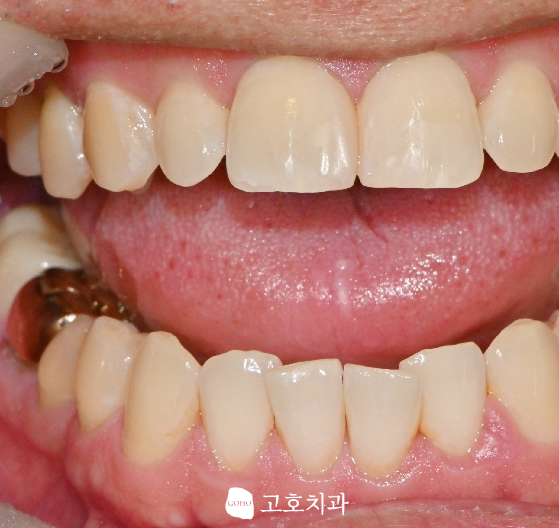 고호치과의원 어금니 보철 상태 검진 장면