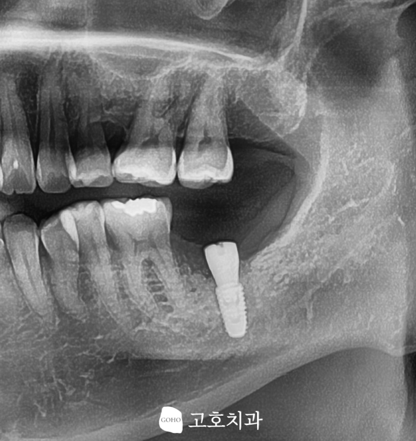 건강보험 임플란트 식립과 골유착 진행 과정
