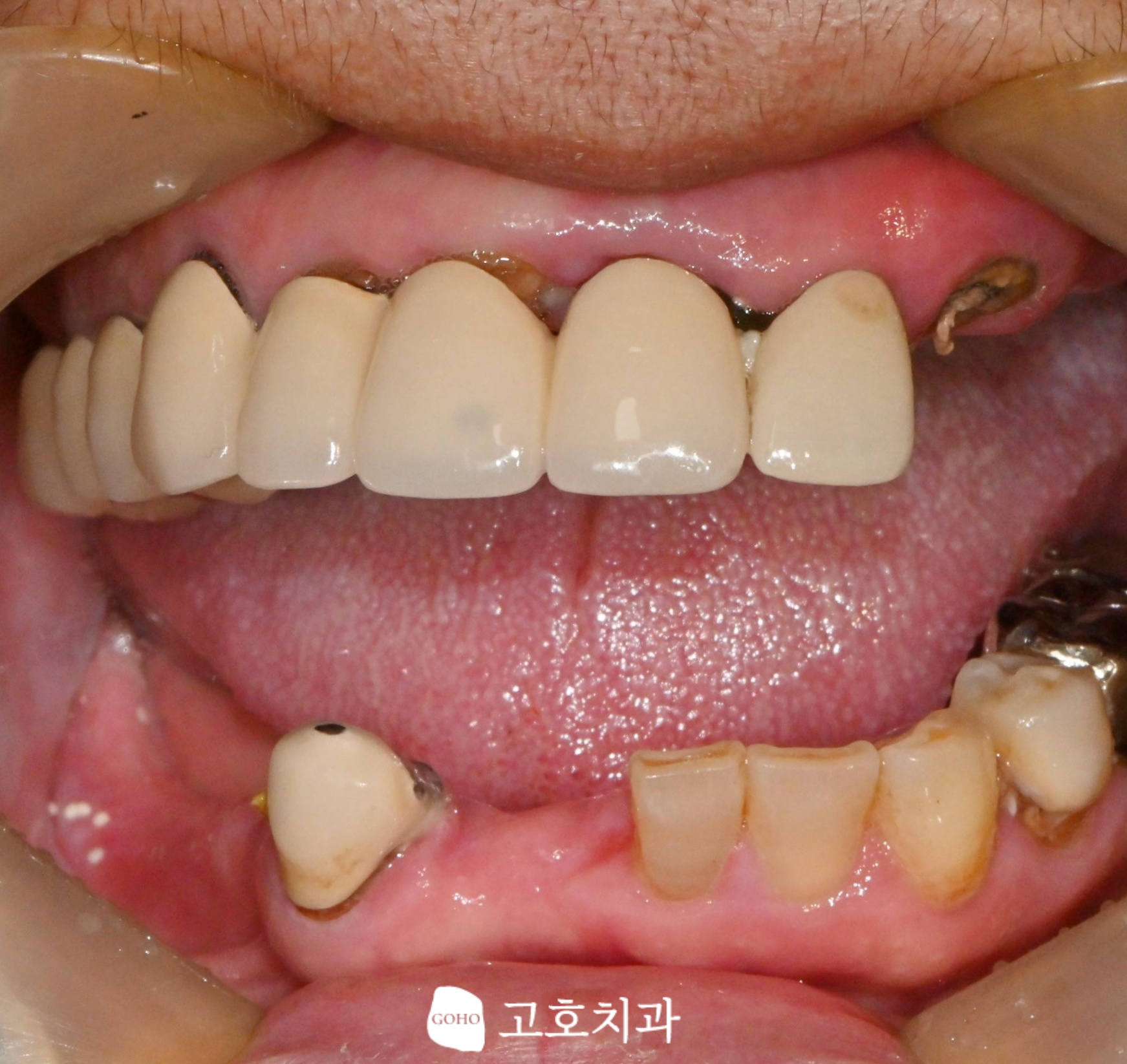 고호치과의원 임플란트 건강보험 적용 대상 상담 장면