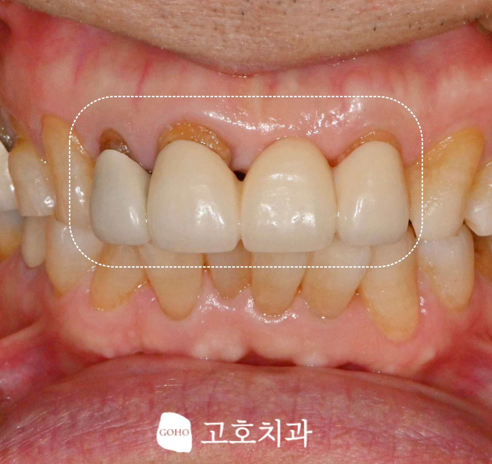 보철물 상태 및 잇몸 라인 검진